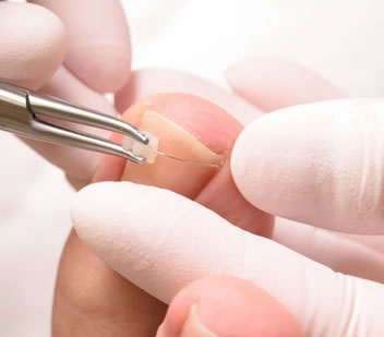 巻き爪の原因と予防 痛くない足爪ケアはドクターネイル爪革命