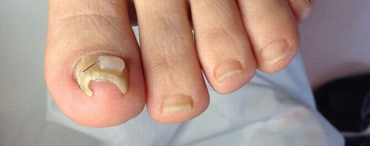 巻き爪の原因と予防 痛くない足爪ケアはドクターネイル爪革命