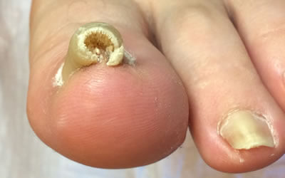 Ingrown toenails(mens entry)