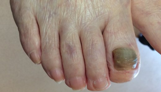 足の親指の爪が黒い｜肥厚爪ケアの事例32