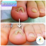 巻き爪　ほくしん