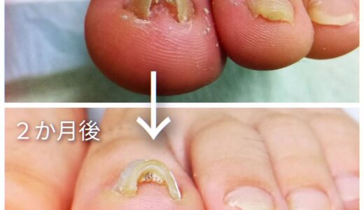 巻き爪ケアの事例31