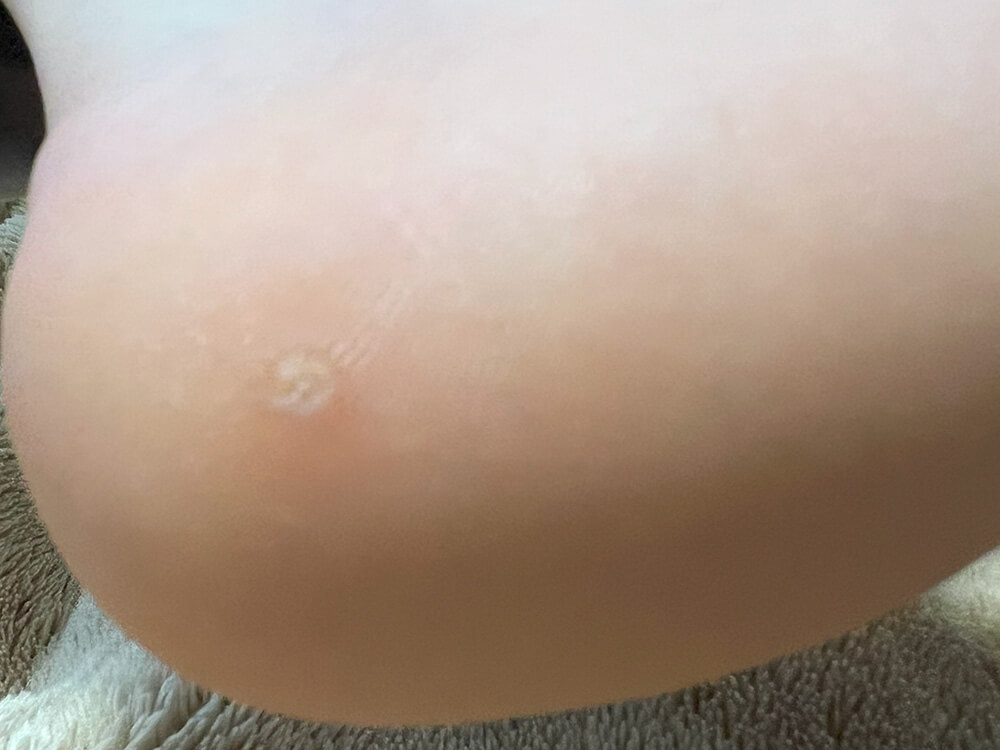 ウイルス性のイボと病院の皮膚科で診断された画像2、かかと部分。