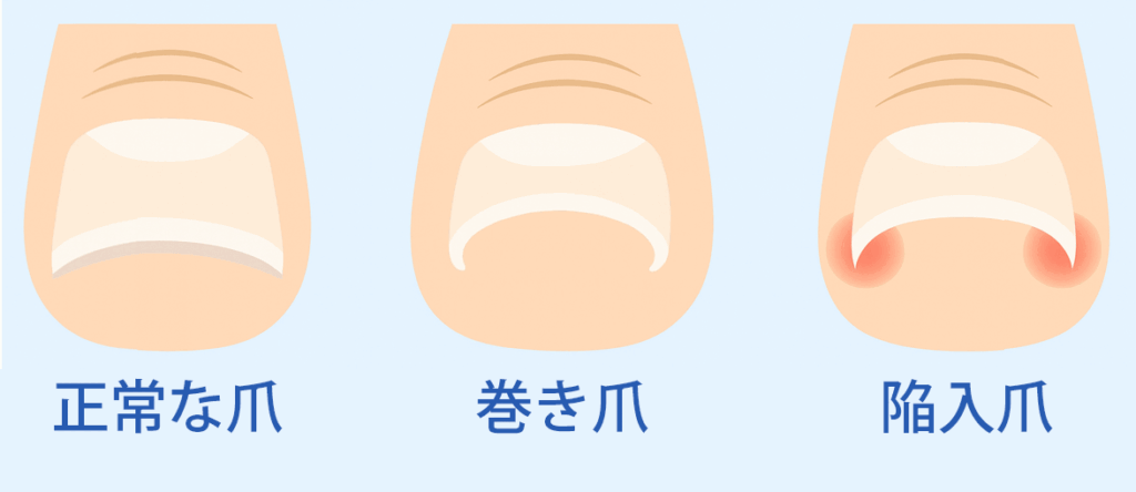 巻き爪と陥入爪の違いを説明するイラスト画像
