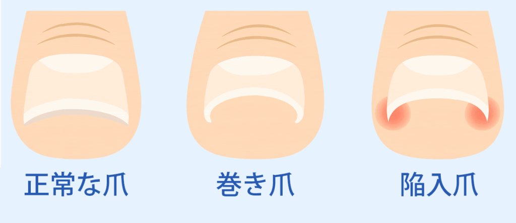 巻き爪と陥入爪の違いを説明するイラスト画像