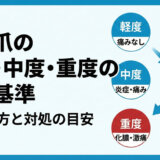 巻き爪の軽度・中道・重度の判断基準｜見分け方と対処の目安